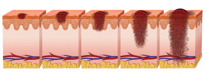 melanoma